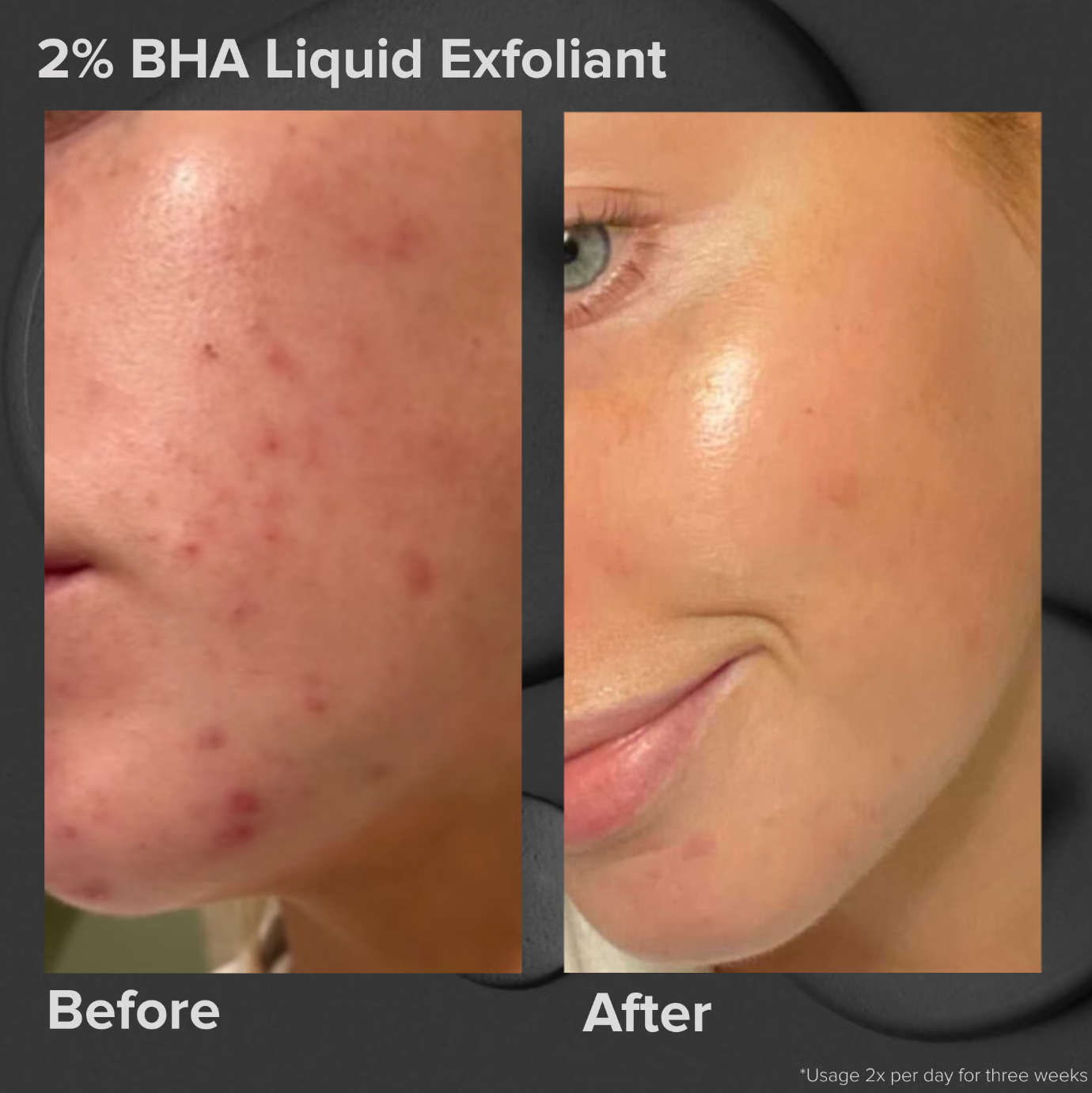 Paula's Choice Skin Perfecting 2% BHA Liquid Exfoliant