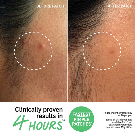 The INKEY List Hydrocolloid Invisible Pimple Patches